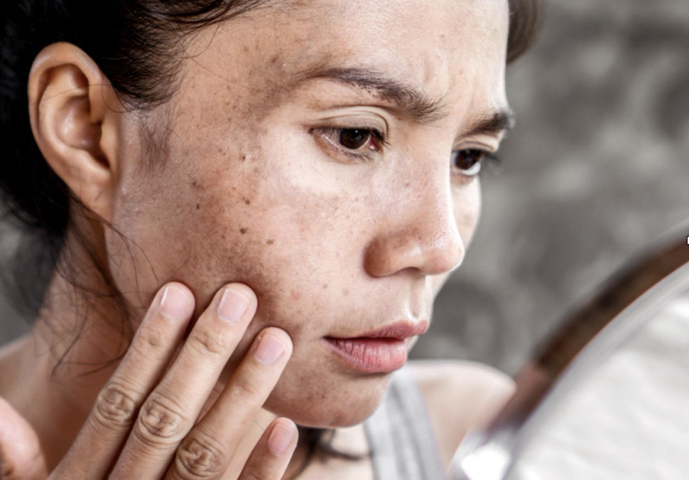 Spotlight on Hyperpigmentation: How to Treat Sun Damage Post-Summer